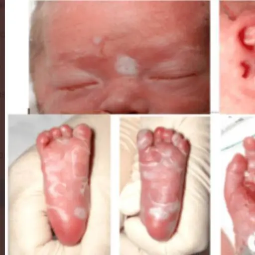 sifilis-congenita-ninos-roosevelt.png ,