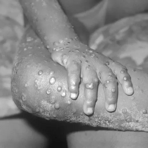 viruela-mono-como-se-transmite-cuales-son-sintomas-publinews-3.jpg ,