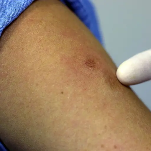 casos-viruela-mono-europa-mayo-2022-publinews-1.jpg ,