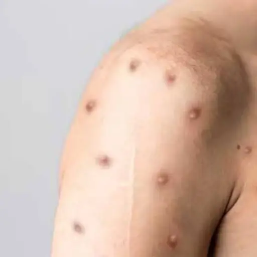 Nuevos-sintomas-de-la-viruela-del-mono-dolor-rectal-e-hinchazon-en-el-pene.jpg ,