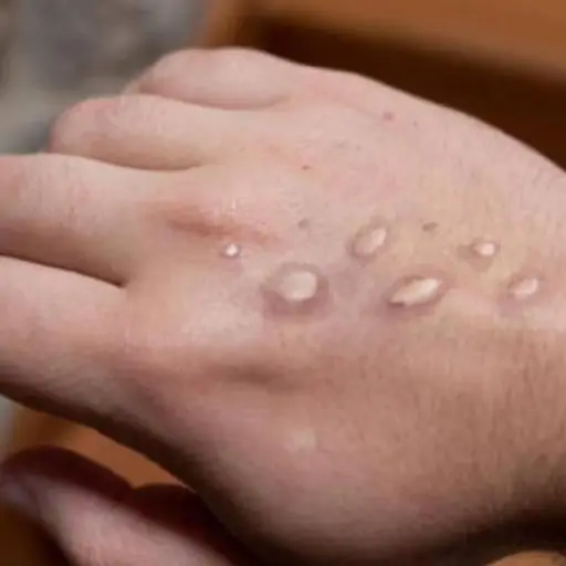 Salud-confirma-cuatro-nuevos-casos-de-viruela-del-mono-en-Guatemala-1-1.jpg ,