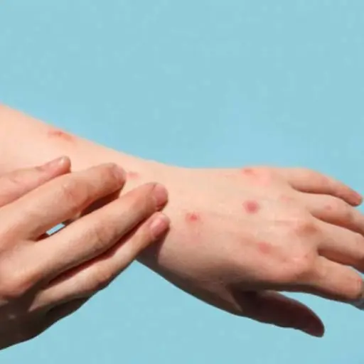 viruela-del-simio.jpg ,