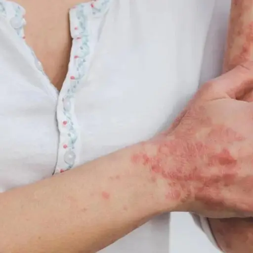 viruela_mono_enfermedad_piel_pixabay-29-septiembre-2022-1.jpg ,