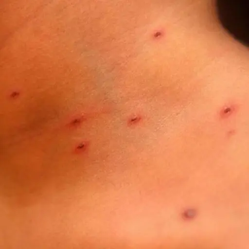 El-regreso-inaceptable-del-sarampion-a-EEUU.jpeg ,