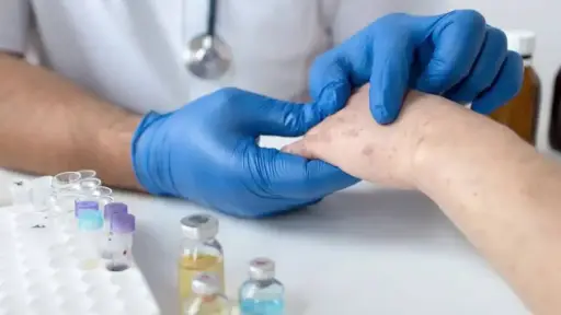 Un paciente evaluado por riesgo de sarampión. ,Ilustrativa de archivo