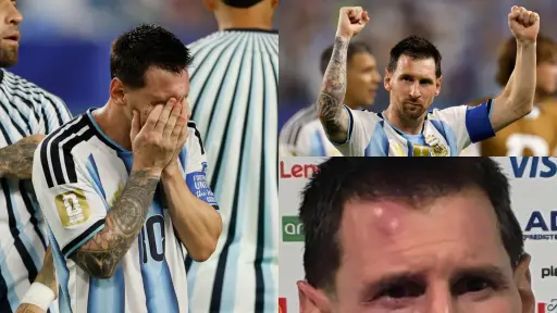 Lionel Messi terminó con un chichón tras el partido entre Argentina vs. Cabo Verde 